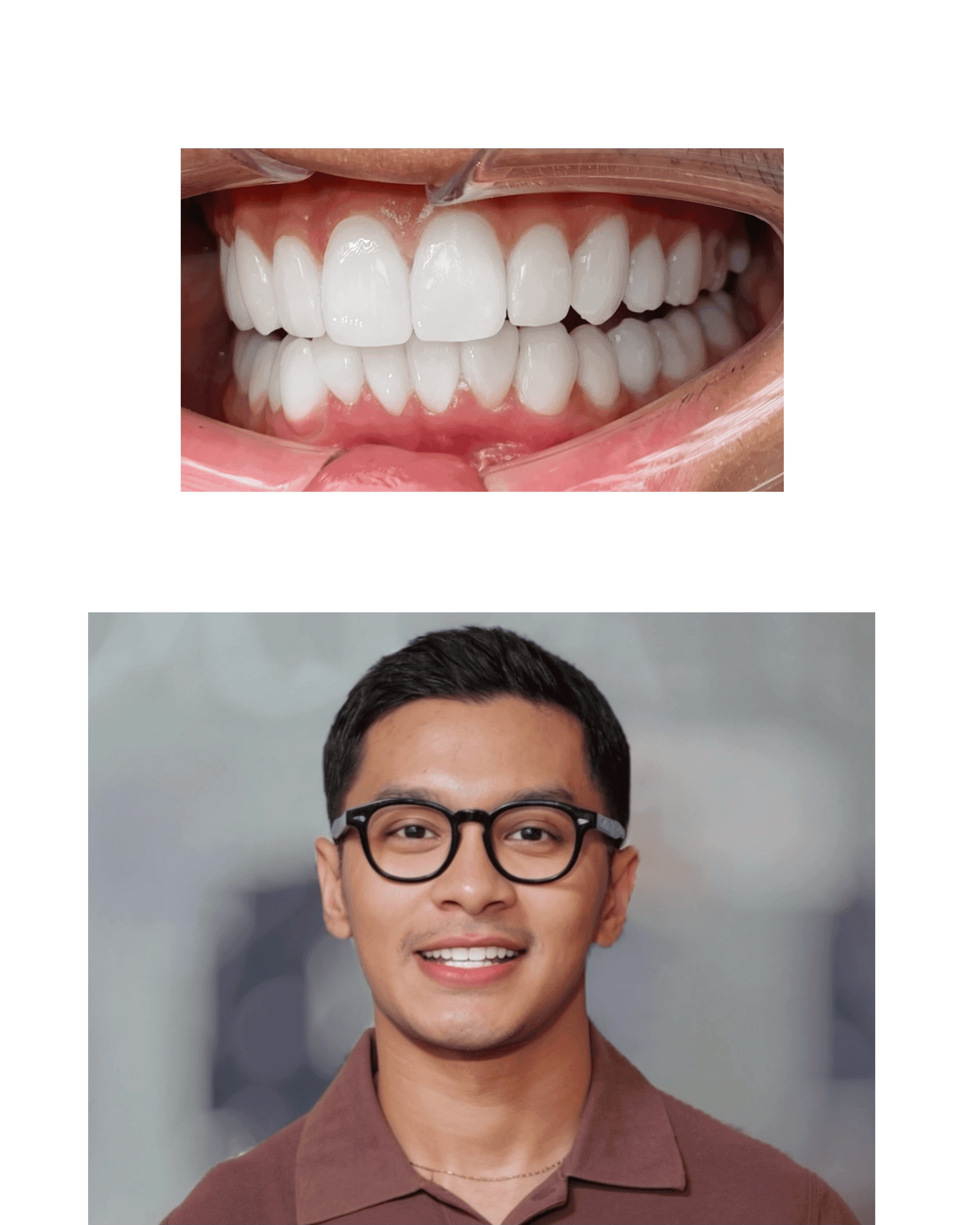 Smile result — Porcelain Veneer by Mustanir Afif
