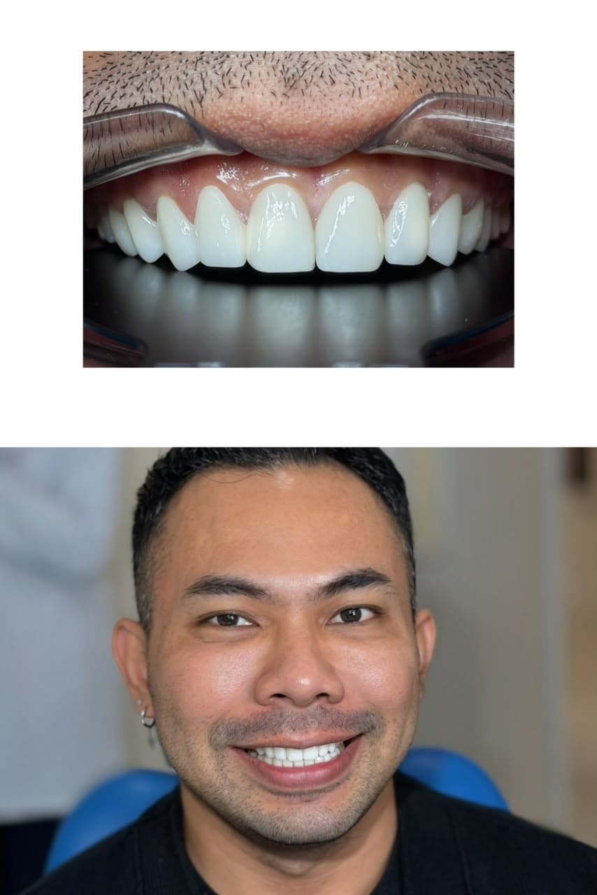 Smile result — Porcelain Veneer by Nobita