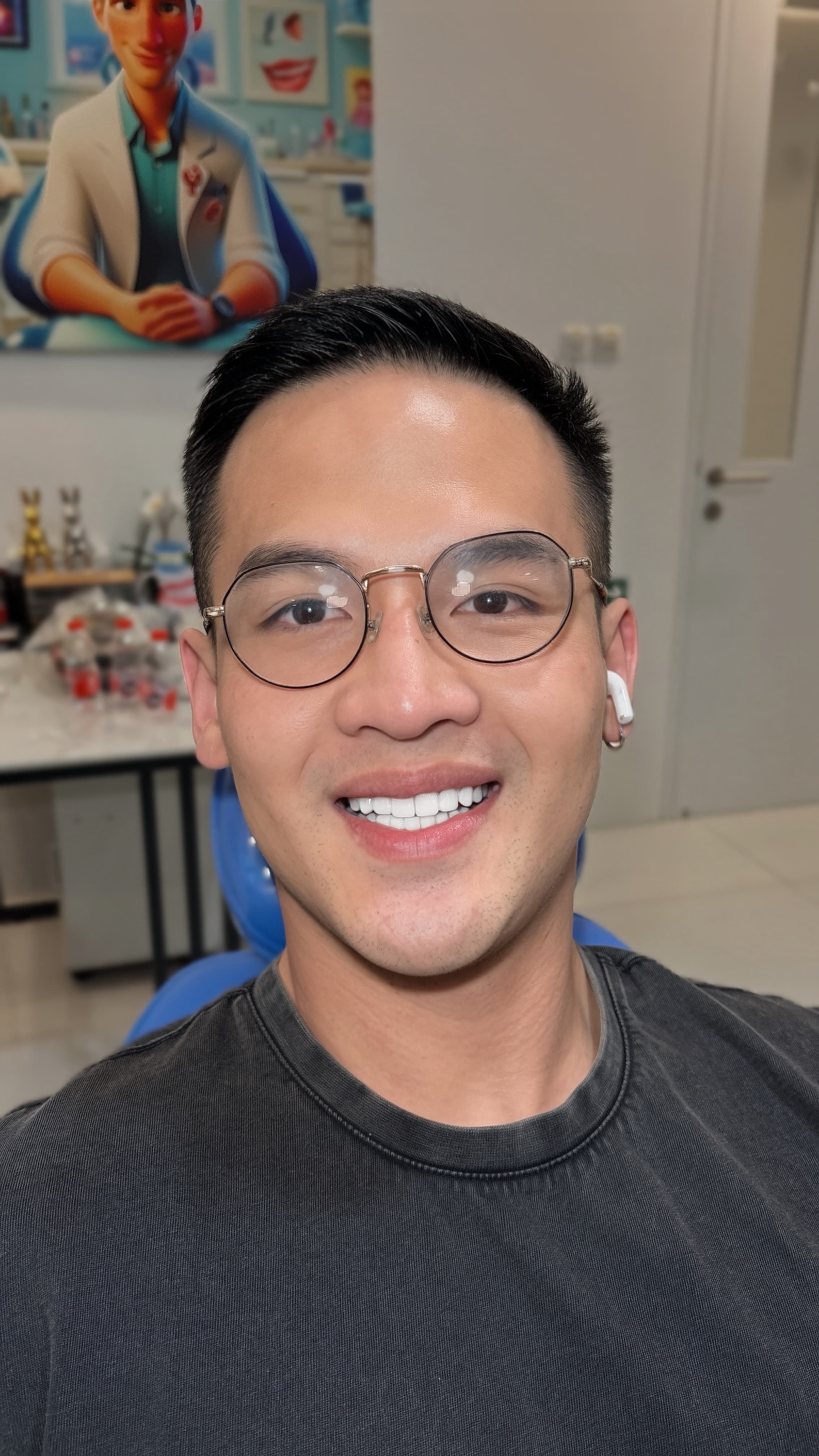 Smile result — Composite Veneer by Kitsakon