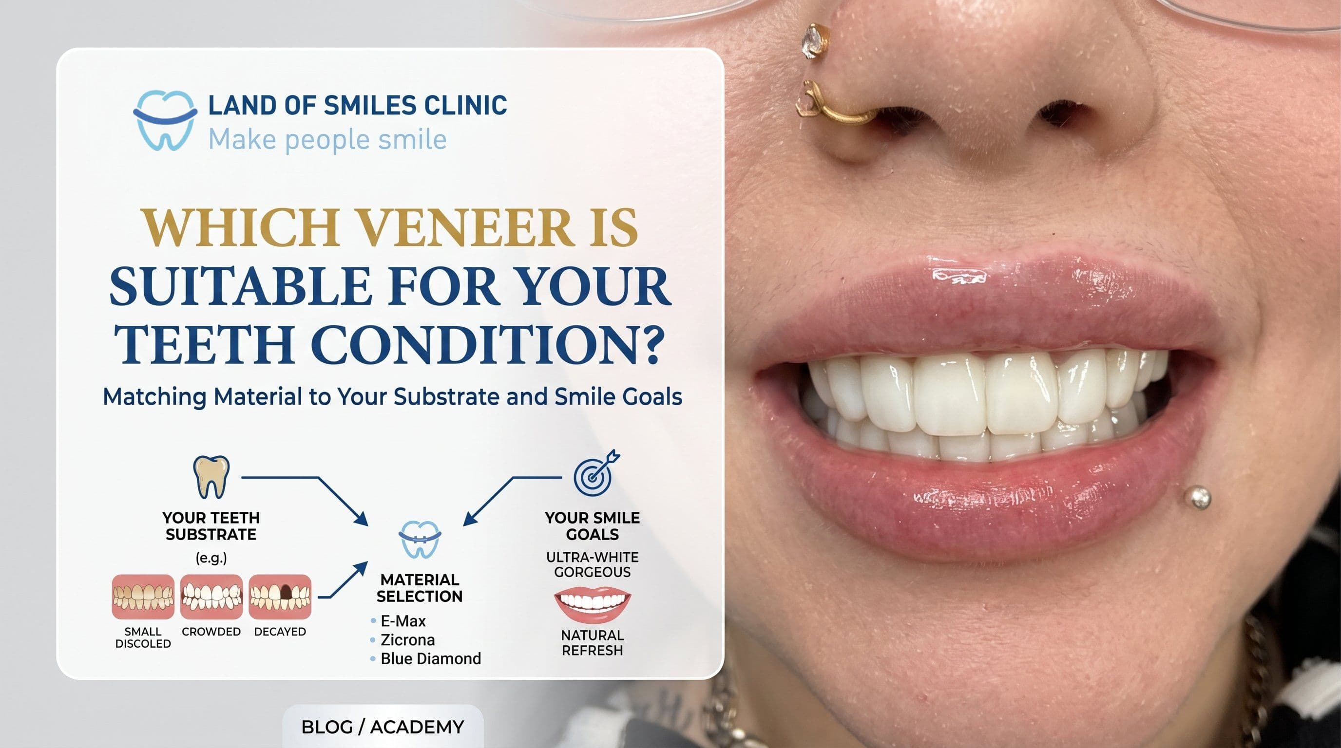Which Veneer Is Suitable for Your Teeth Condition? Matching Material to Your Substrate and Smile Goals